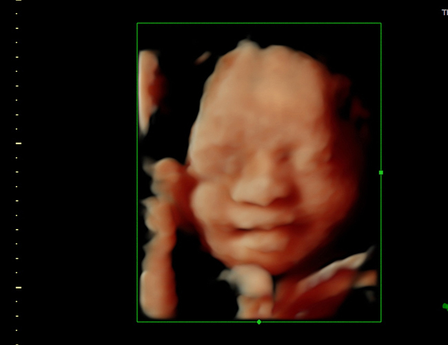 3D ultrasound image at 29 weeks